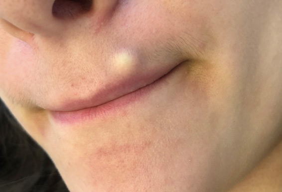 cyst on upper lip