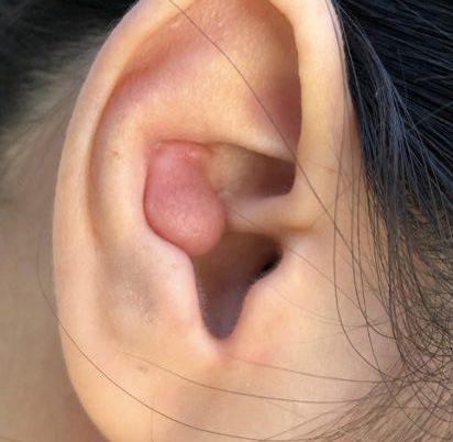 keloid on ear