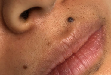 Mole Removal   Texas Facial Aesthetics (txfaces.com)