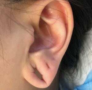 Split Earlobe Repair for Toronto & Barrie