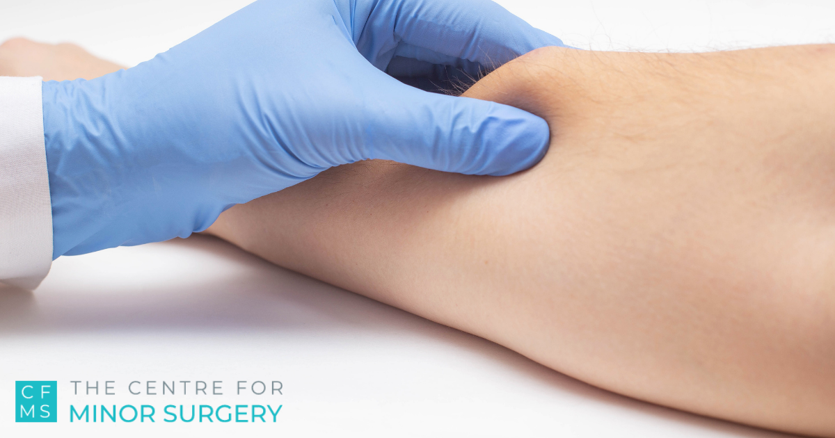 general surgeon near me lipoma