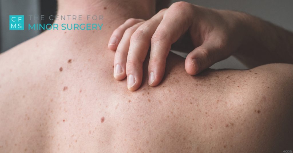 Close-up of a person examining a dermatofibroma on their upper back (model)
