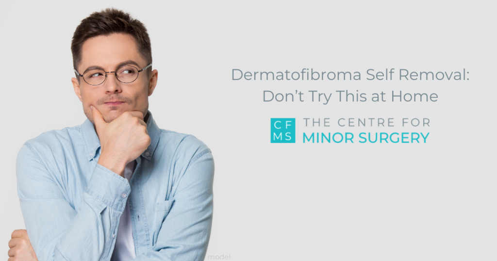 Young man curious about Dermatofibroma self removal