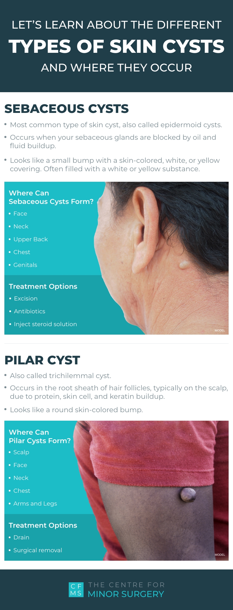 Types of cysts infographic