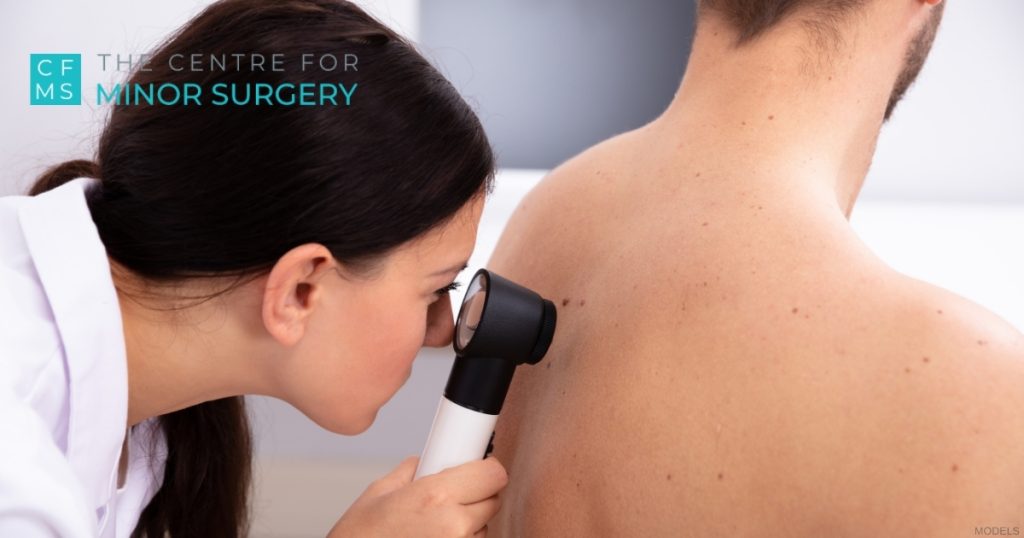 Doctor examining a mole on a man’s back with a dermatoscope (models)