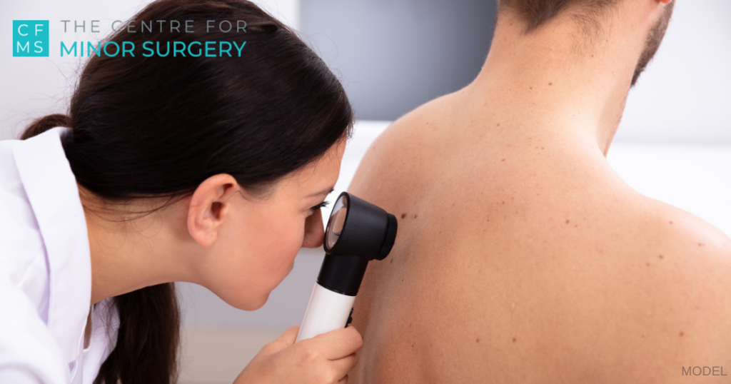 Female Doctor Examining Skin On Man's Back With Dermatoscope (model)
