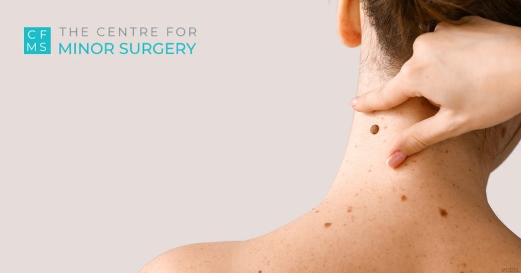 Woman examining a mole on the back of her neck (model)