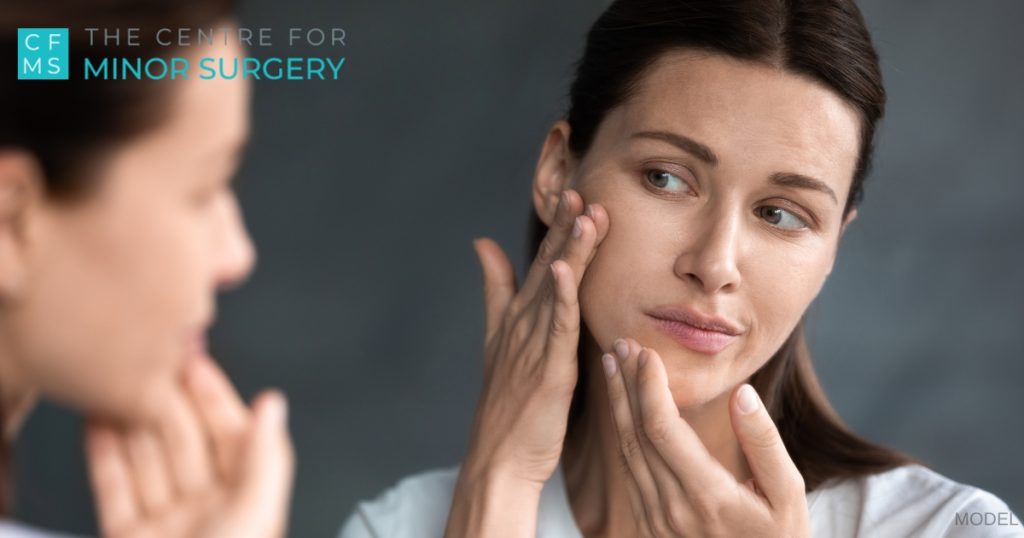 Close up unhappy woman looking at skin lesions in mirror (model)