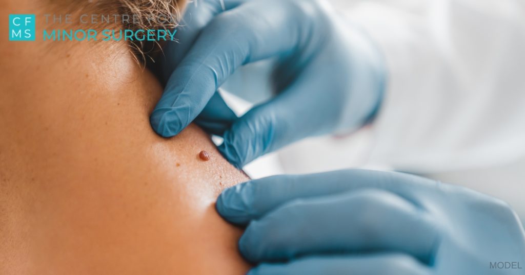 Close up of dermatologist examining patient skin tag in clinic (model)