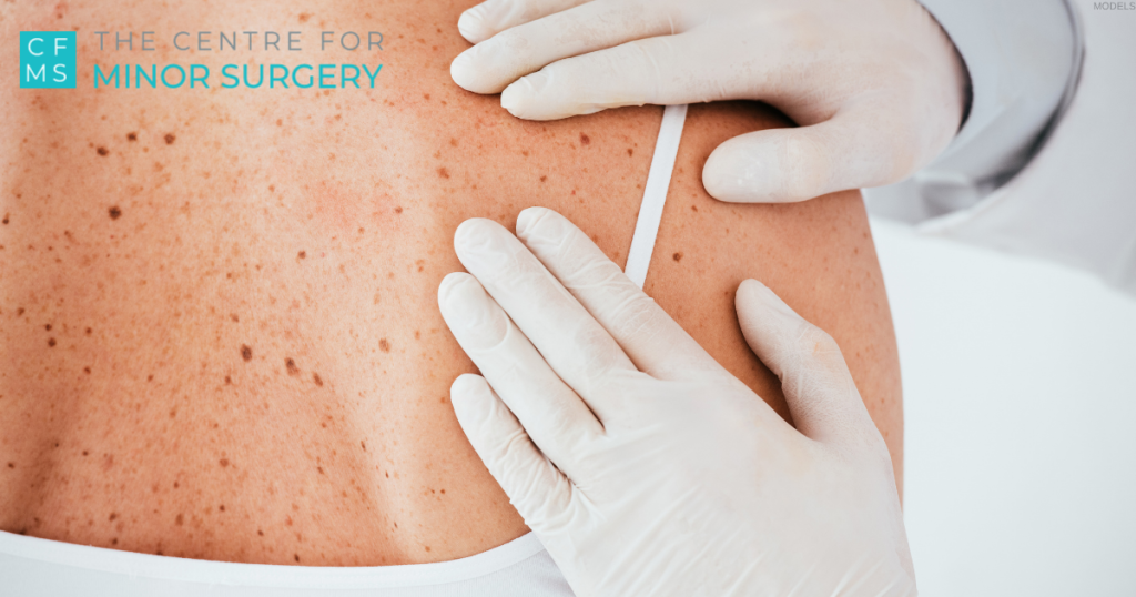 Dermatologist in latex gloves examining woman with skin cancer (models)
