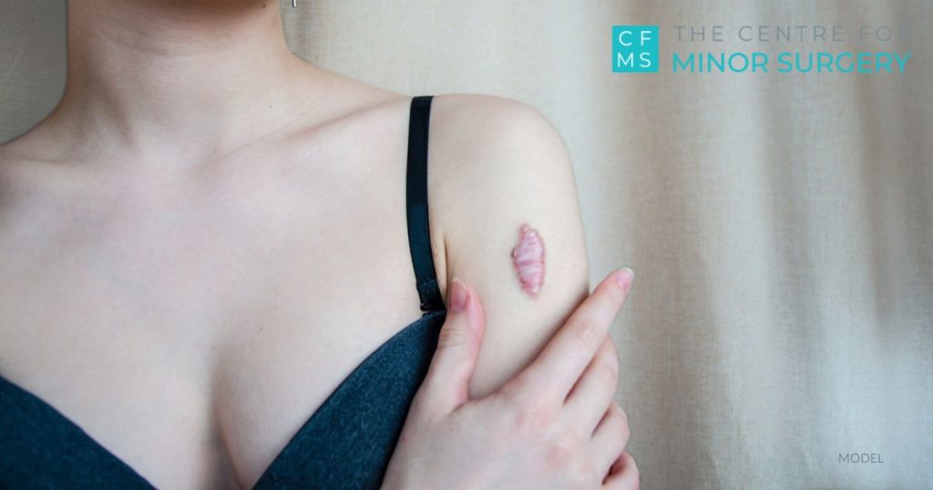 A woman is holding her arm. The are has a scar or keloid on it. (MODEL)