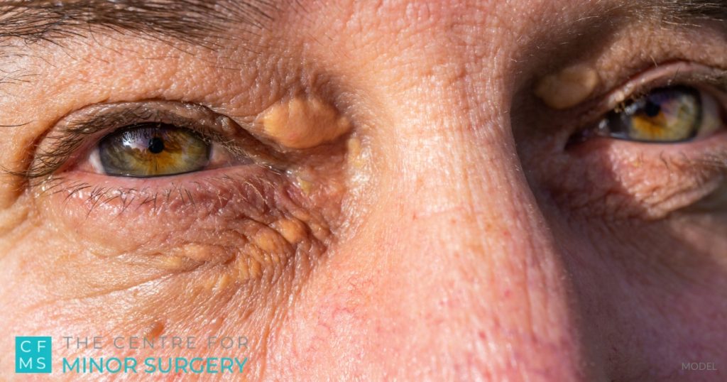 Xanthelasma on a man's eye region (MODEL)