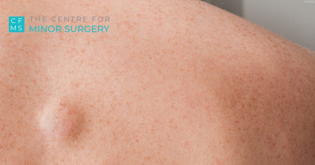 Close-up of a lipoma on a person’s back with The Centre for Minor Surgery logo (model)