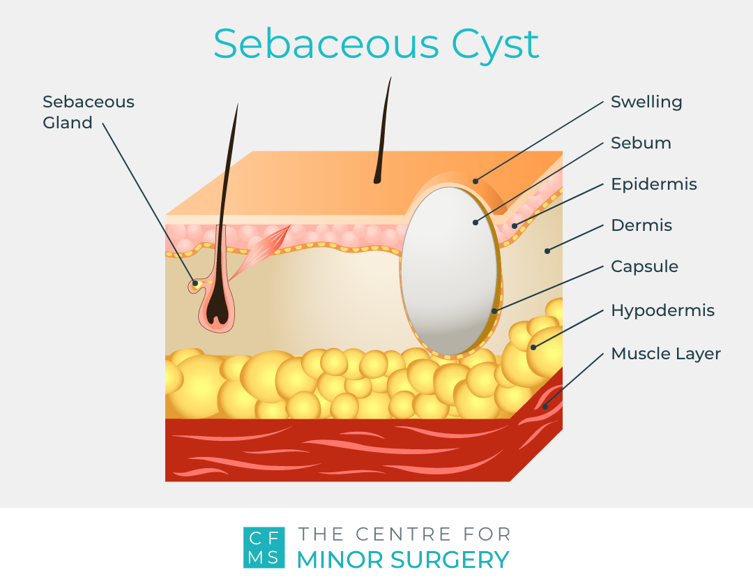 What Causes A Sebaceous Cyst Centre For Minor Surgery what-causes-a-sebaceous-cyst-centre-for-minor-surgery