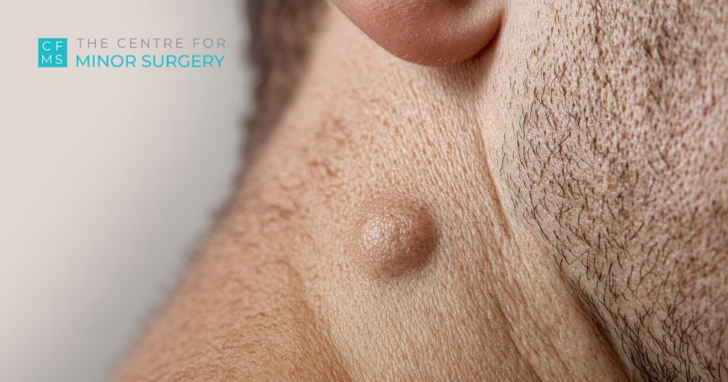 Close-up of a lipoma on a man's neck below the ear, with The Centre for Minor Surgery logo (model).